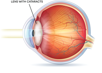 cataracts3
