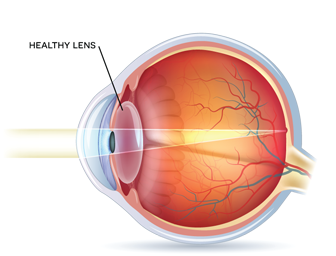 cataracts4