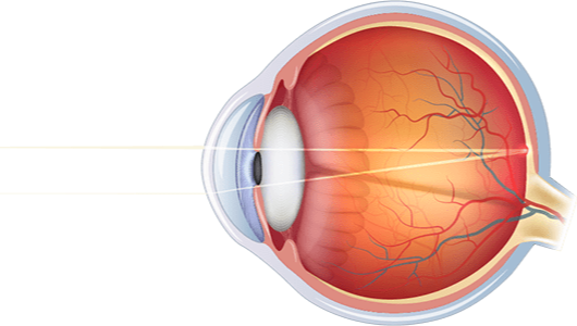 Lasik1