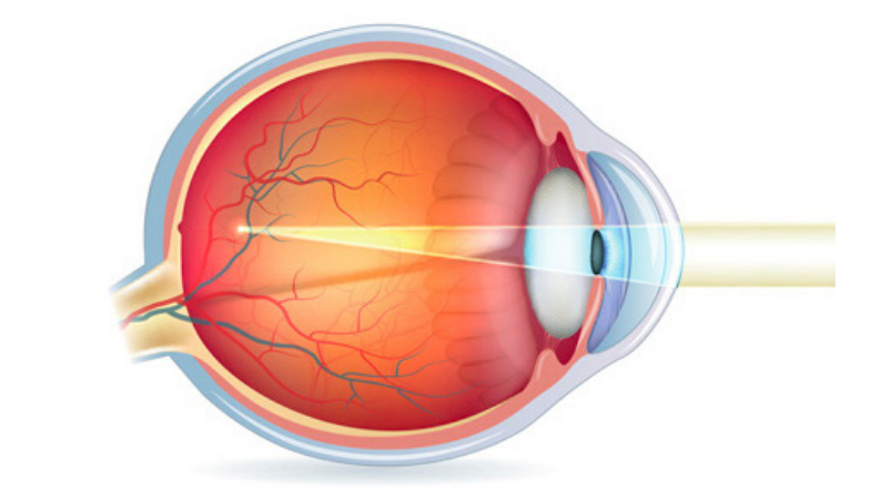 Lasik2